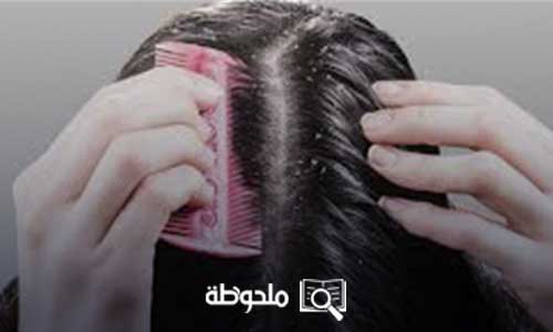 طرق علاج القشرة في الشعر