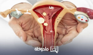 علاج قرحة الرحم